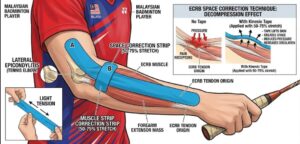 kinesio taping on forearm and elbow for lateral epicondylitis in a malaysian badminton player showing ecrb space correction technique